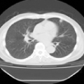 肺がんCT検診